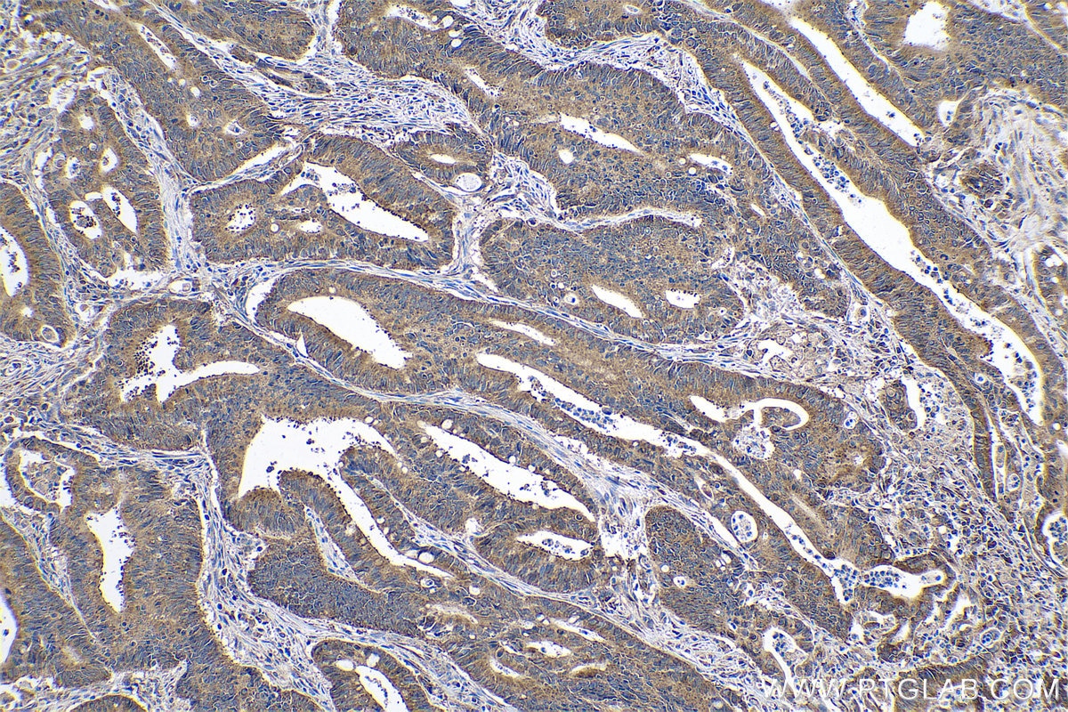 Immunohistochemical analysis of paraffin-embedded human colon cancer tissue slide using KHC0508 (EEF1A1 IHC Kit).