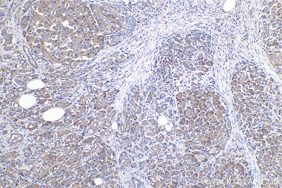 Immunohistochemical analysis of paraffin-embedded human pancreas cancer tissue slide using KHC0508 (EEF1A1 IHC Kit).