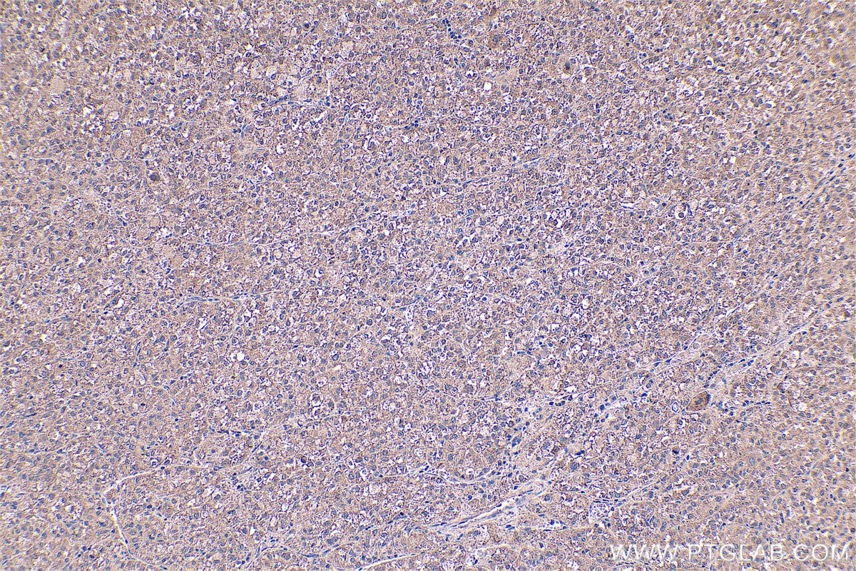 Immunohistochemical analysis of paraffin-embedded human liver cancer tissue slide using KHC0563 (EEF1A2 IHC Kit).