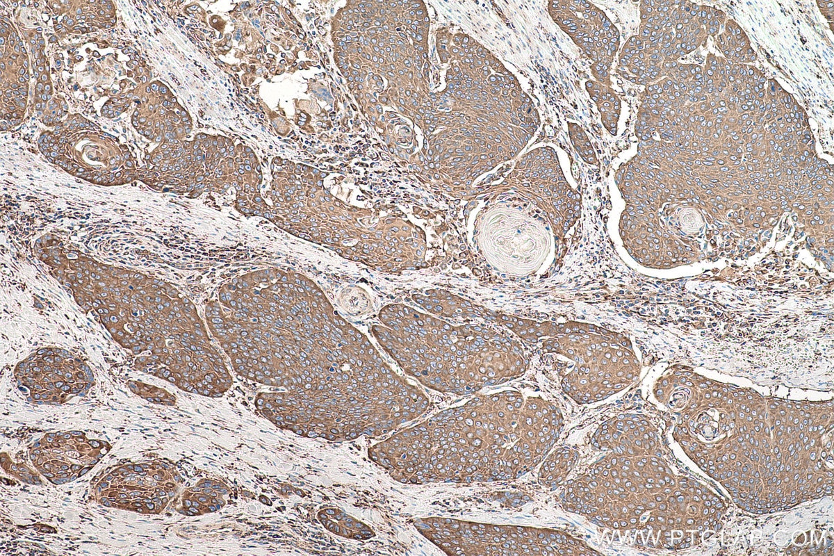Immunohistochemical analysis of paraffin-embedded human oesophagus cancer tissue slide using KHC0852 (EEF1D IHC Kit).