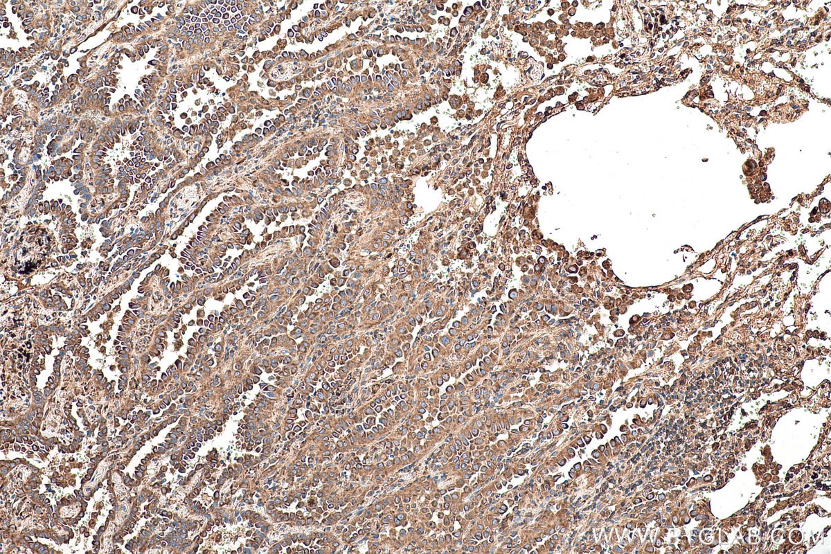 Immunohistochemical analysis of paraffin-embedded human lung cancer tissue slide using KHC0852 (EEF1D IHC Kit).