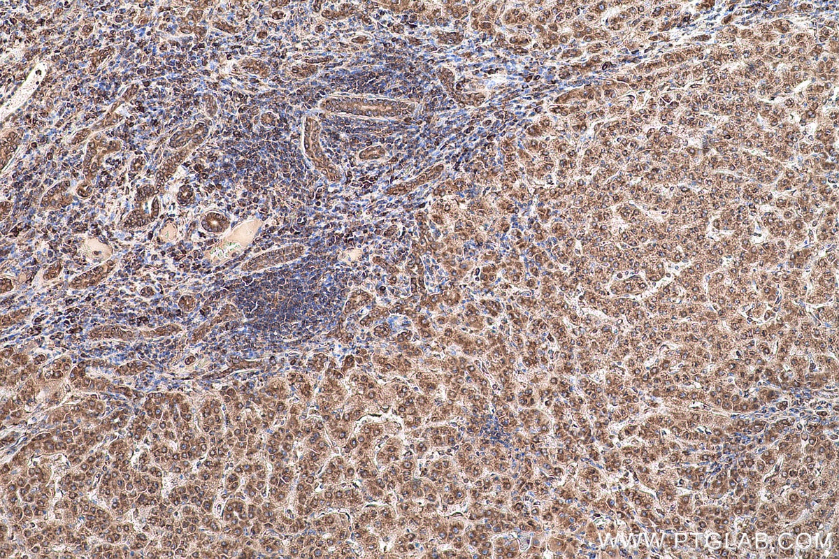 Immunohistochemical analysis of paraffin-embedded human liver cancer tissue slide using KHC0852 (EEF1D IHC Kit).
