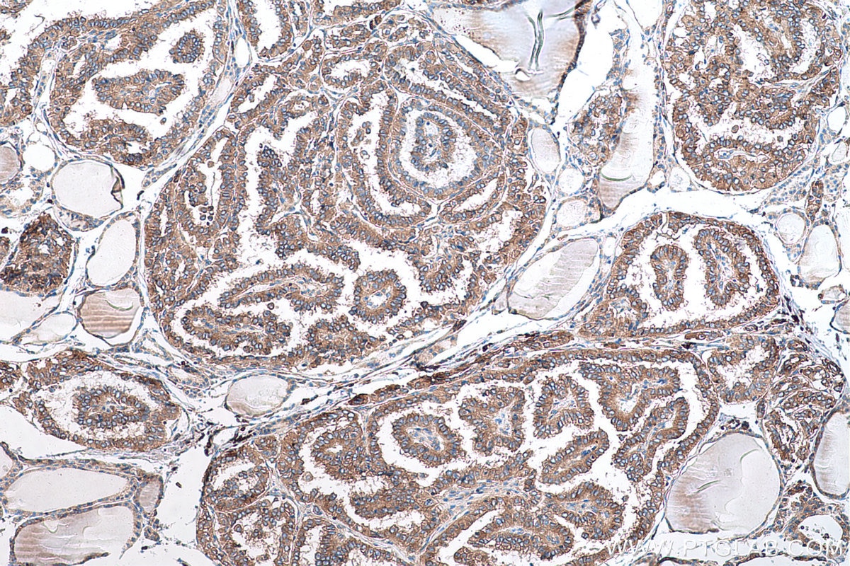 Immunohistochemical analysis of paraffin-embedded human thyroid cancer tissue slide using KHC0585 (EEF2 IHC Kit).