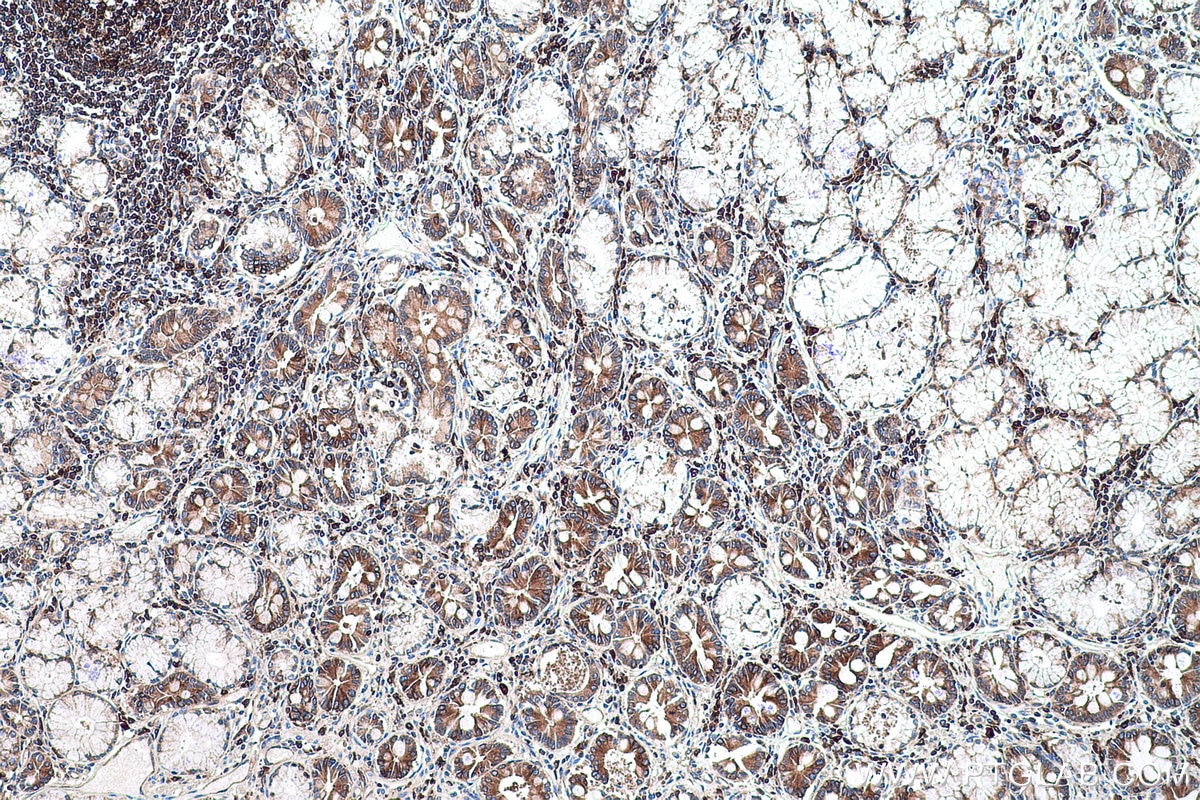 Immunohistochemical analysis of paraffin-embedded human stomach cancer tissue slide using KHC0585 (EEF2 IHC Kit).