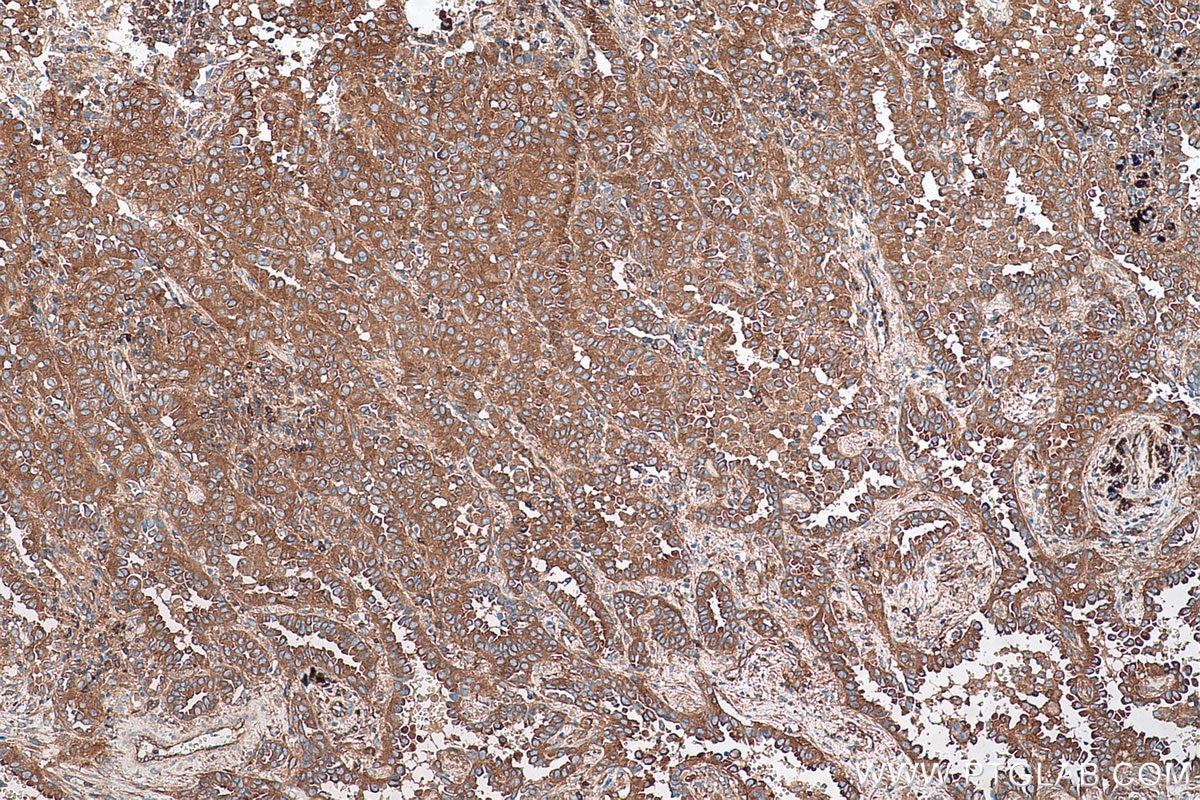 Immunohistochemical analysis of paraffin-embedded human lung cancer tissue slide using KHC0585 (EEF2 IHC Kit).