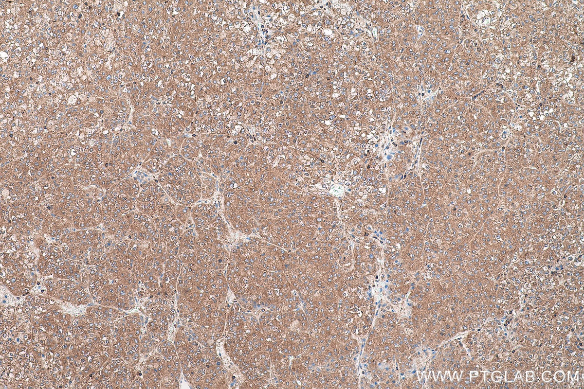 Immunohistochemical analysis of paraffin-embedded human liver cancer tissue slide using KHC0585 (EEF2 IHC Kit).