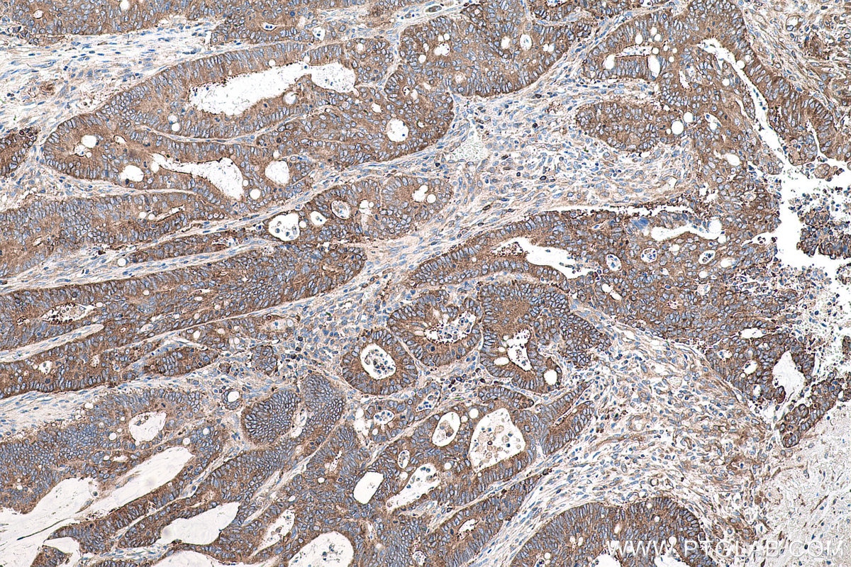 Immunohistochemical analysis of paraffin-embedded human colon cancer tissue slide using KHC0585 (EEF2 IHC Kit).