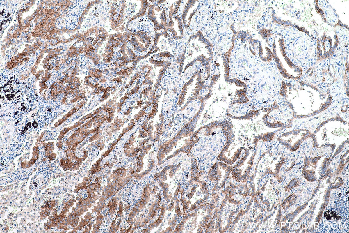 Immunohistochemical analysis of paraffin-embedded human lung cancer tissue slide using KHC0612 (EGFR IHC Kit).