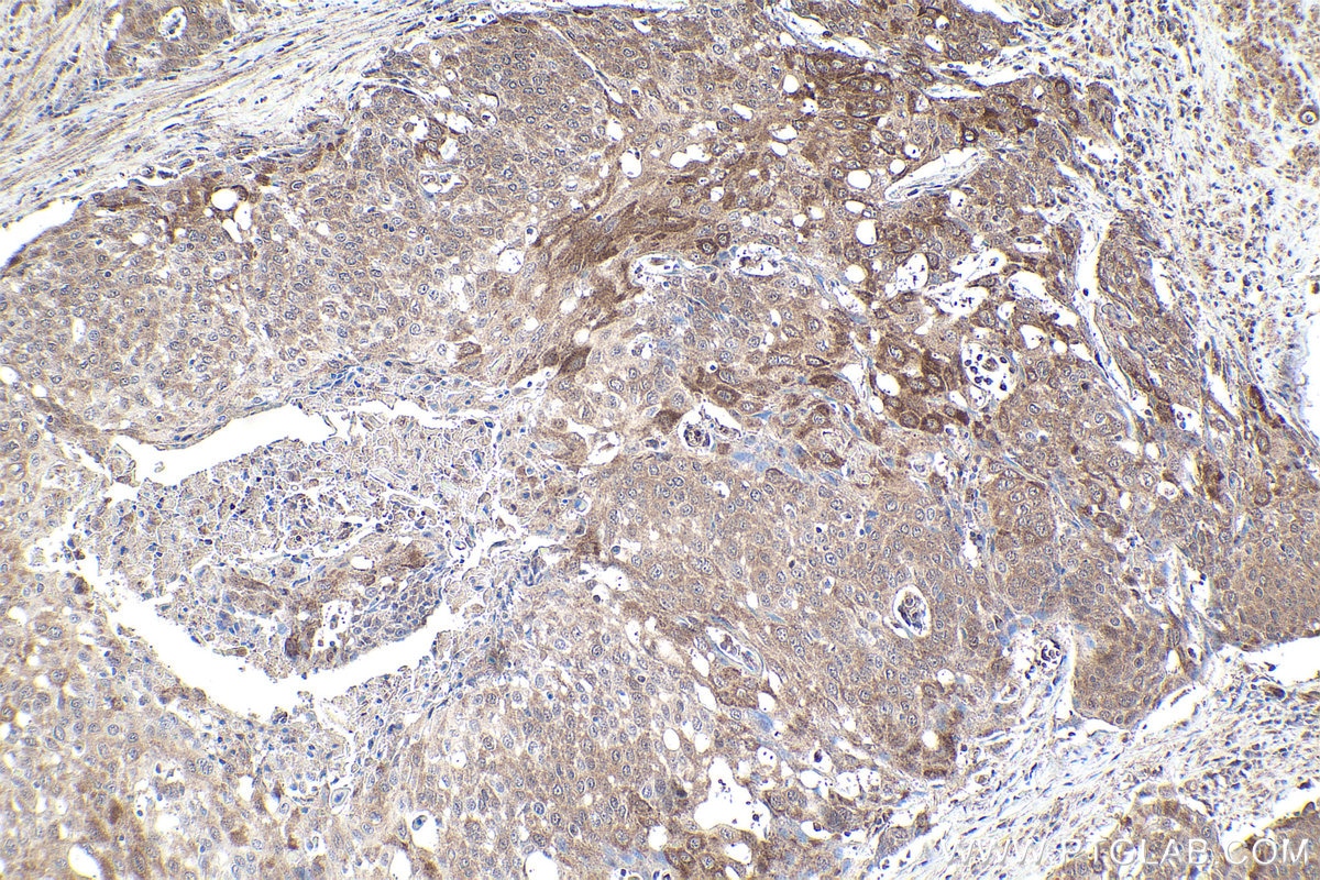 Immunohistochemical analysis of paraffin-embedded human cervical cancer tissue slide using KHC1935 (EGLN3 IHC Kit).