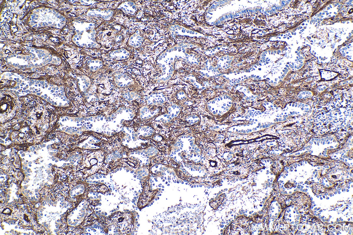Immunohistochemical analysis of paraffin-embedded human lung cancer tissue slide using KHC1291 (EHD2 IHC Kit).