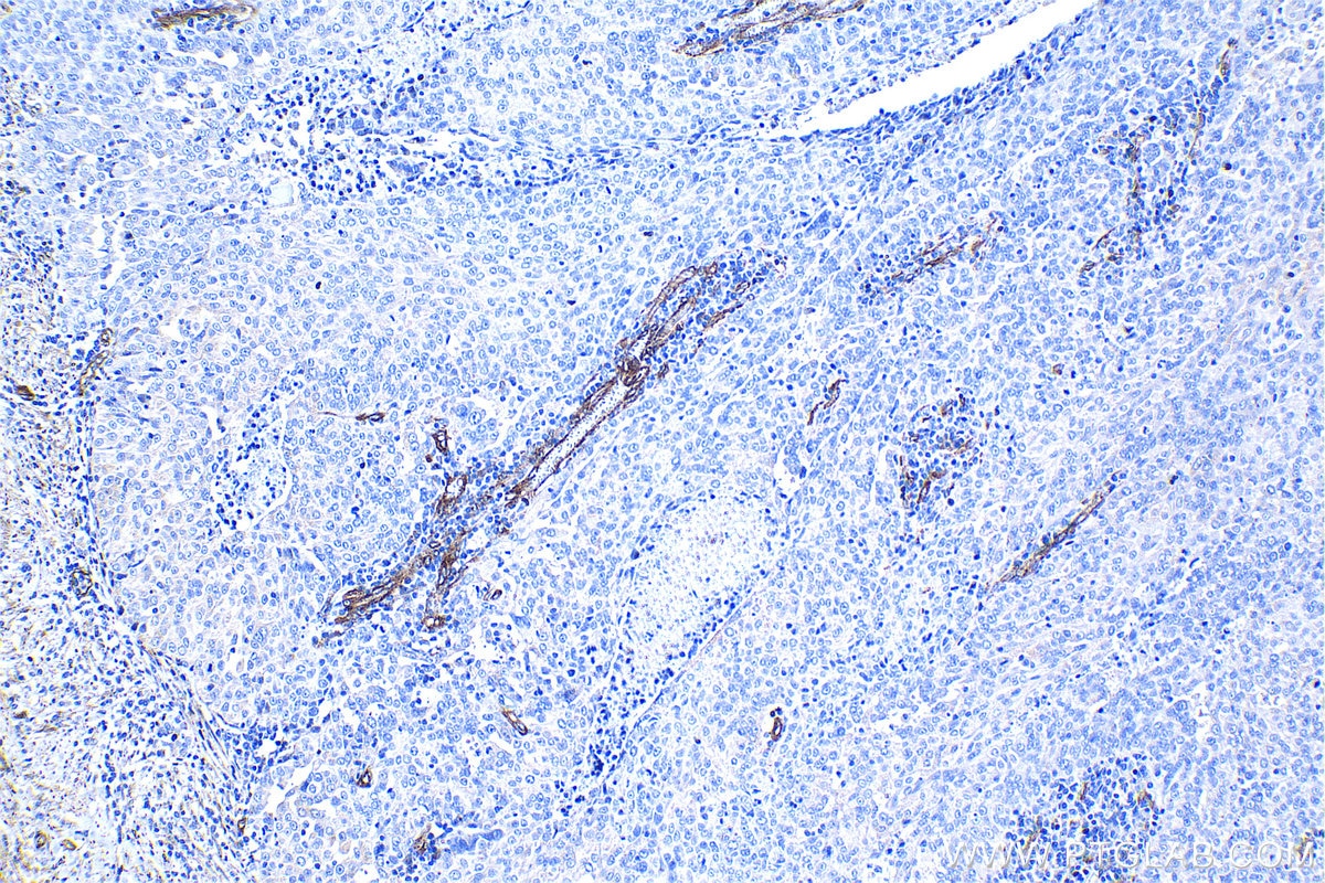Immunohistochemical analysis of paraffin-embedded human ovary tumor tissue slide using KHC1291 (EHD2 IHC Kit).