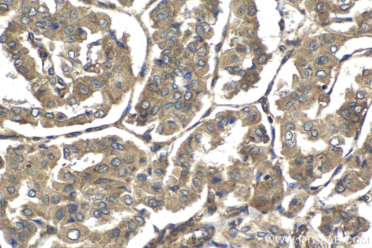 Immunohistochemical analysis of paraffin-embedded human thyroid cancer tissue slide using KHC1546 (EIF2AK2, PKR IHC Kit).
