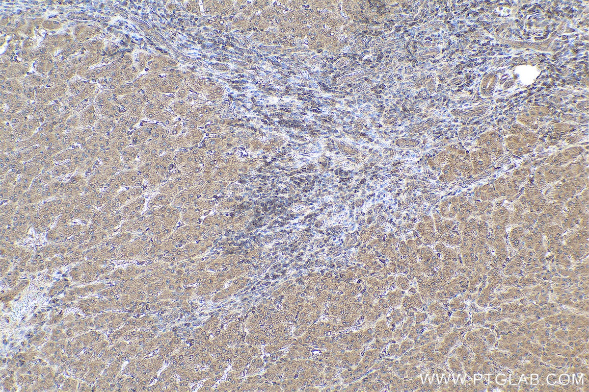 Immunohistochemical analysis of paraffin-embedded human liver cancer tissue slide using KHC0796 (EIF2C1 IHC Kit).