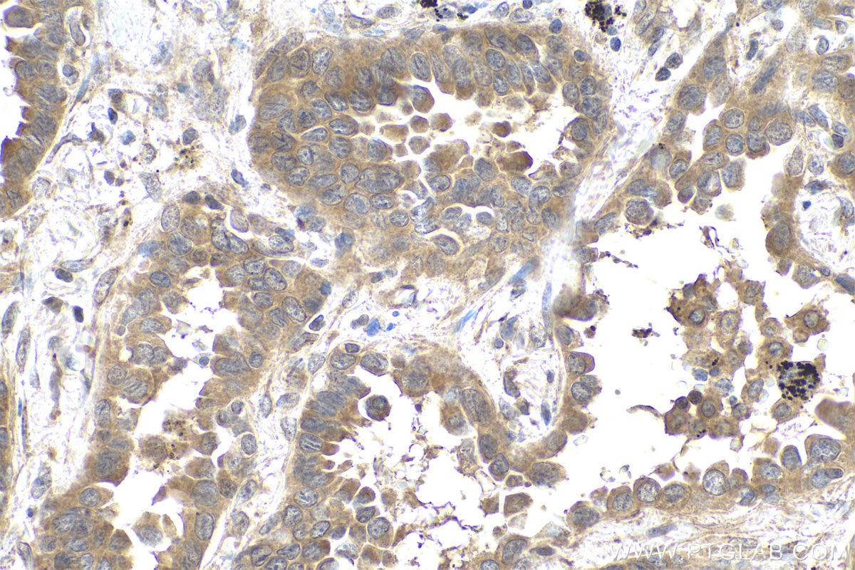Immunohistochemical analysis of paraffin-embedded human lung cancer tissue slide using KHC0796 (EIF2C1 IHC Kit).