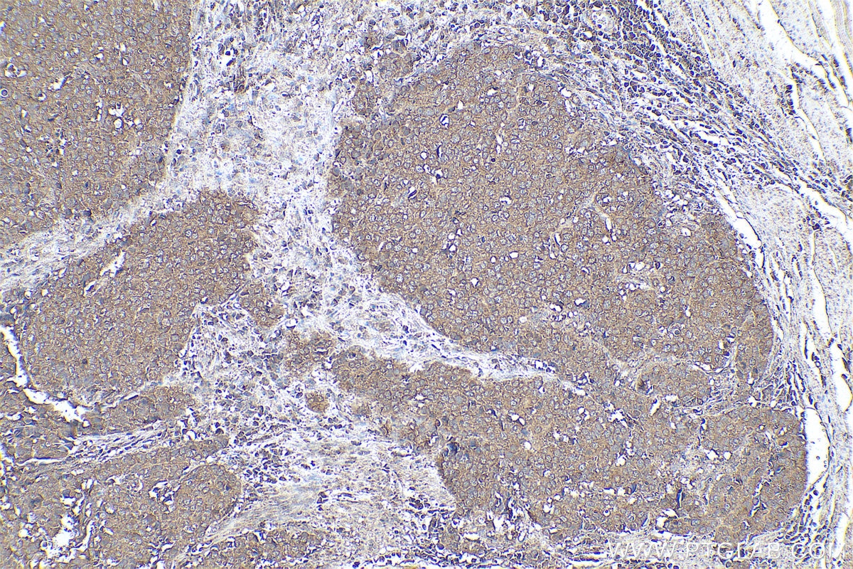 Immunohistochemical analysis of paraffin-embedded human stomach cancer tissue slide using KHC0796 (EIF2C1 IHC Kit).