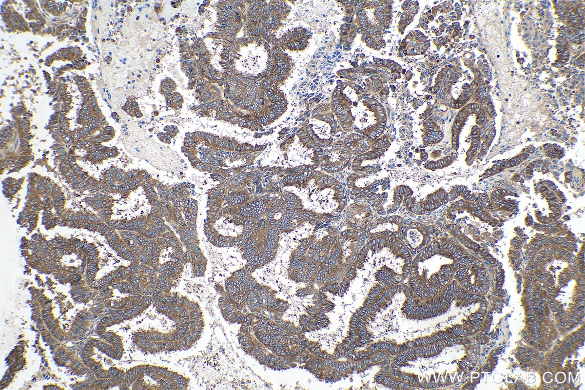 Immunohistochemical analysis of paraffin-embedded human ovary tumor tissue slide using KHC0167 (EIF3A IHC Kit).