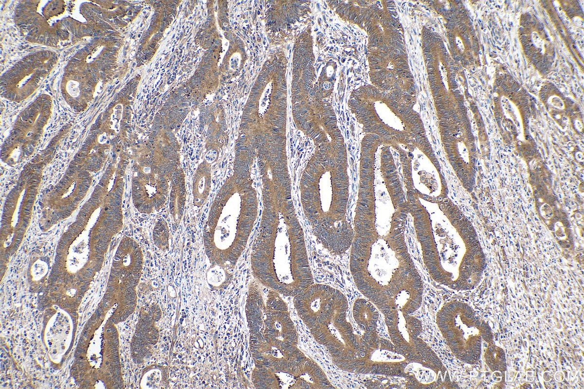 Immunohistochemical analysis of paraffin-embedded human colon cancer tissue slide using KHC0167 (EIF3A IHC Kit).