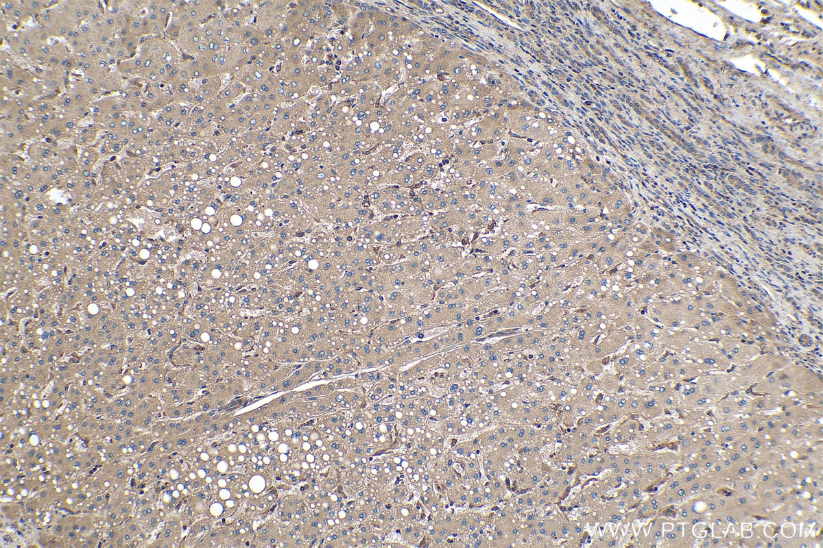 Immunohistochemical analysis of paraffin-embedded human liver cancer tissue slide using KHC0168 (EIF3C IHC Kit).