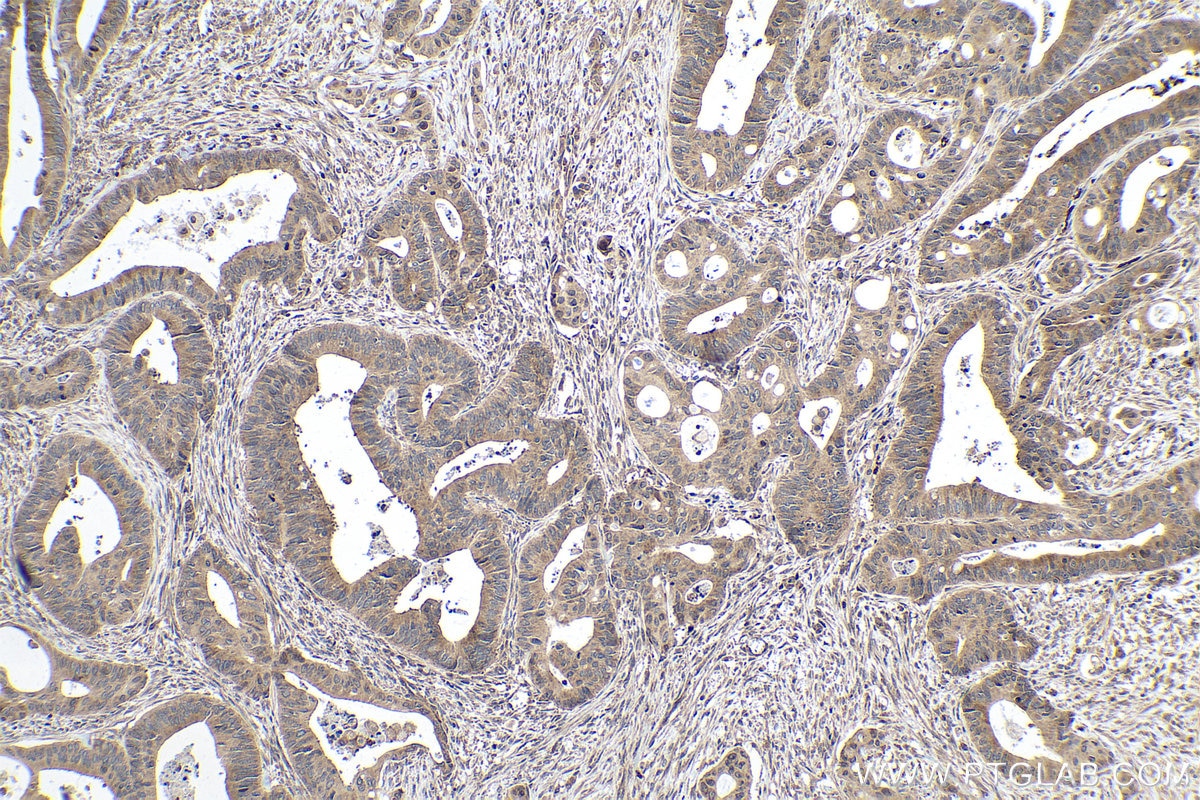 Immunohistochemical analysis of paraffin-embedded human colon cancer tissue slide using KHC0168 (EIF3C IHC Kit).