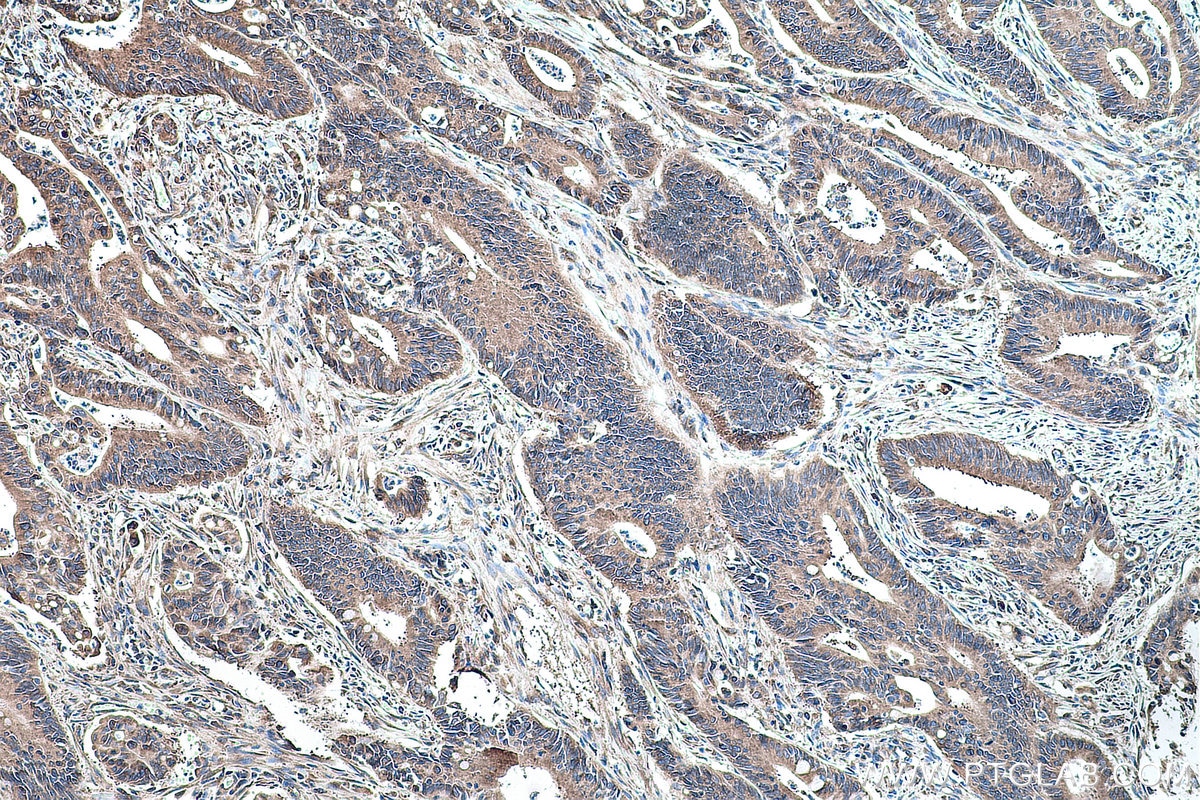 Immunohistochemical analysis of paraffin-embedded human colon cancer tissue slide using KHC0169 (EIF3D IHC Kit).