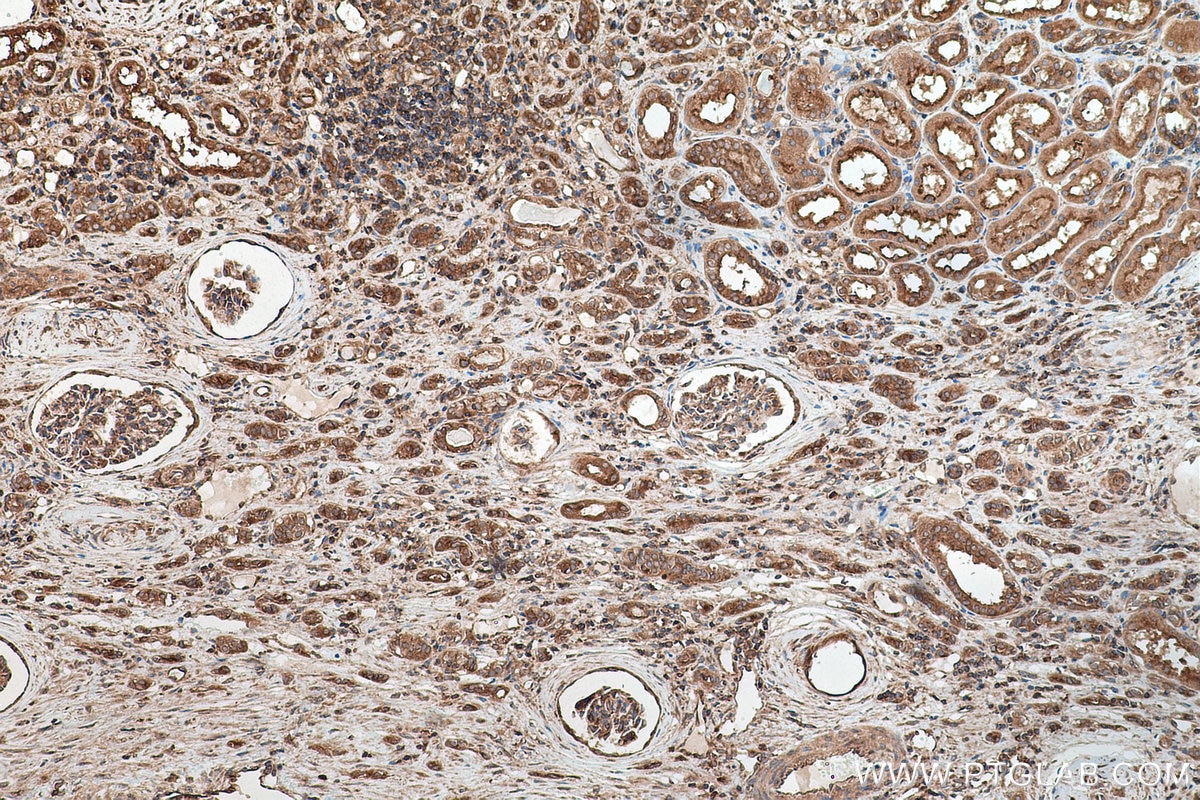 Immunohistochemical analysis of paraffin-embedded human renal cell carcinoma tissue slide using KHC0169 (EIF3D IHC Kit).