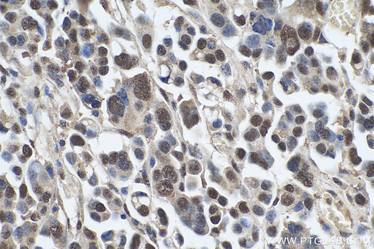 Immunohistochemical analysis of paraffin-embedded human colon cancer tissue slide using KHC0778 (EIF3E IHC Kit).