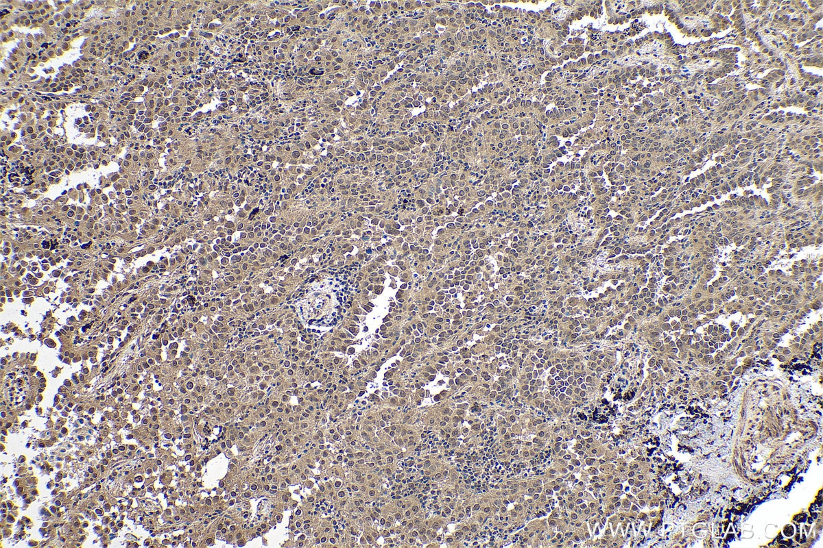 Immunohistochemical analysis of paraffin-embedded human lung cancer tissue slide using KHC0778 (EIF3E IHC Kit).