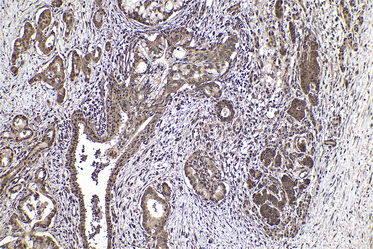 Immunohistochemical analysis of paraffin-embedded human pancreas cancer tissue slide using KHC0778 (EIF3E IHC Kit).