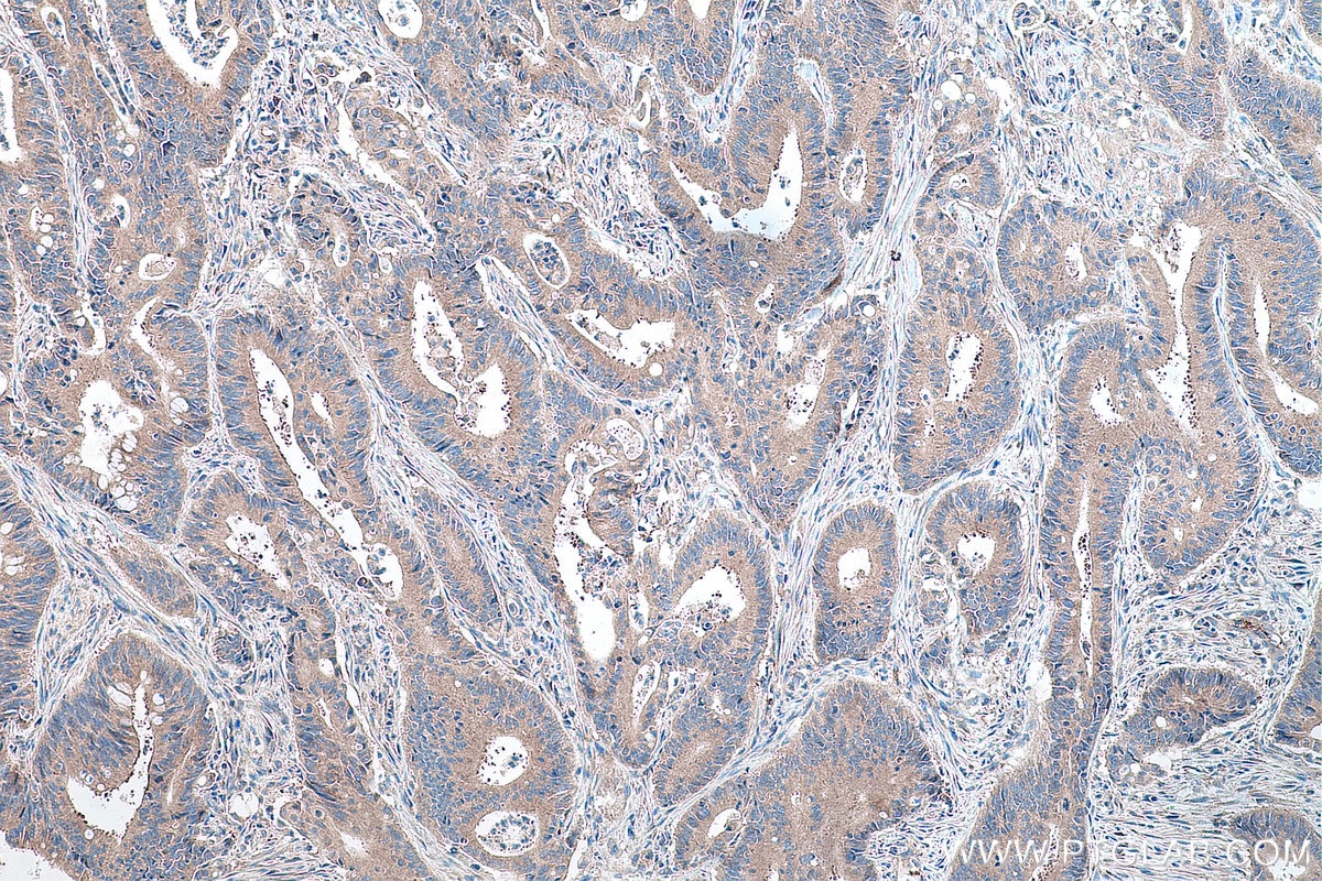 Immunohistochemical analysis of paraffin-embedded human colon cancer tissue slide using KHC0170 (EIF3G IHC Kit).