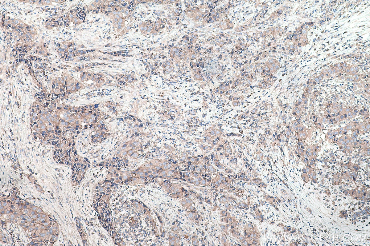 Immunohistochemical analysis of paraffin-embedded human breast cancer tissue slide using KHC0170 (EIF3G IHC Kit).
