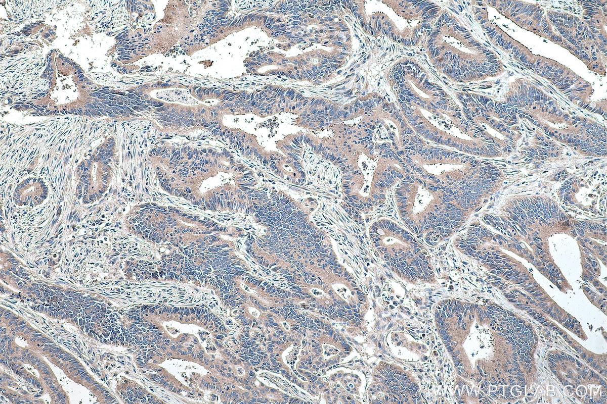 Immunohistochemical analysis of paraffin-embedded human colon cancer tissue slide using KHC0171 (EIF3I IHC Kit).