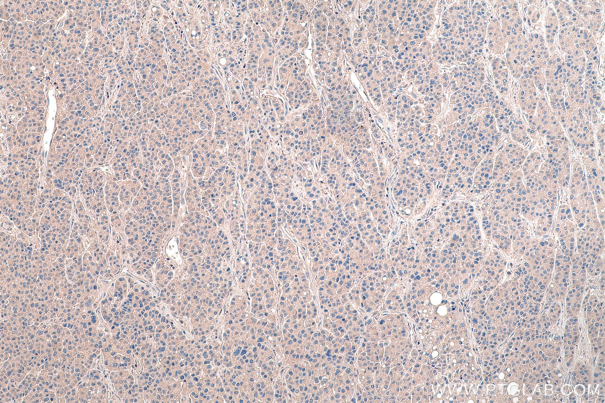 Immunohistochemical analysis of paraffin-embedded human liver cancer tissue slide using KHC0171 (EIF3I IHC Kit).