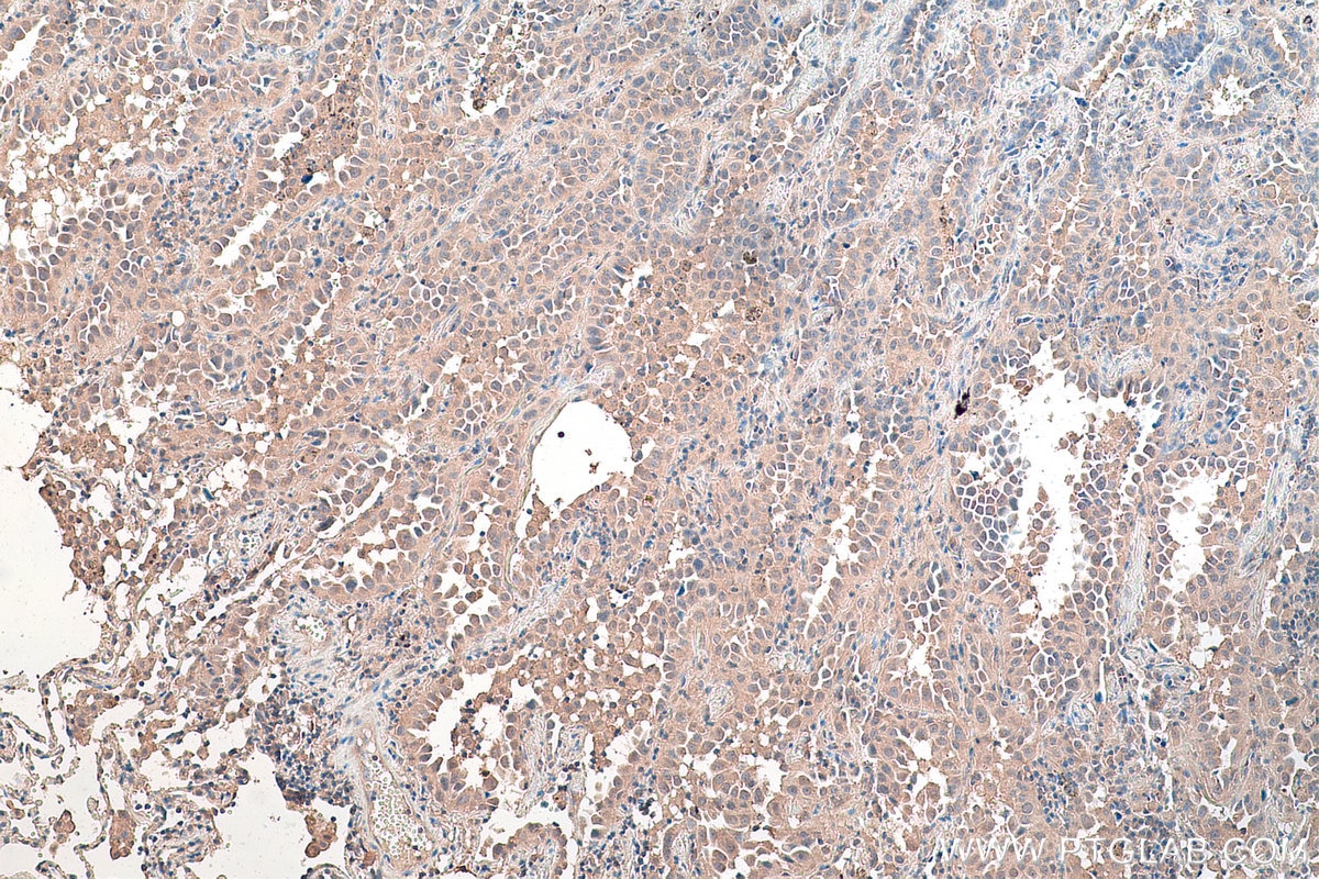 Immunohistochemical analysis of paraffin-embedded human lung cancer tissue slide using KHC0171 (EIF3I IHC Kit).