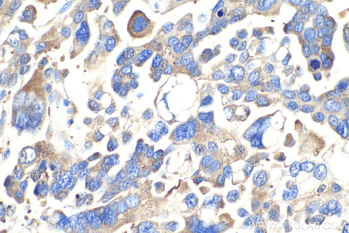 Immunohistochemical analysis of paraffin-embedded human colon cancer tissue slide using KHC0925 (EIF3M IHC Kit).