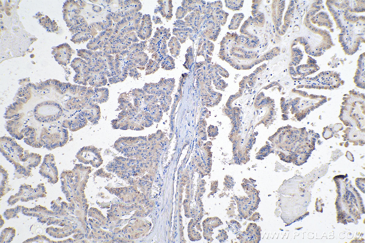 Immunohistochemical analysis of paraffin-embedded human thyroid cancer tissue slide using KHC0925 (EIF3M IHC Kit).