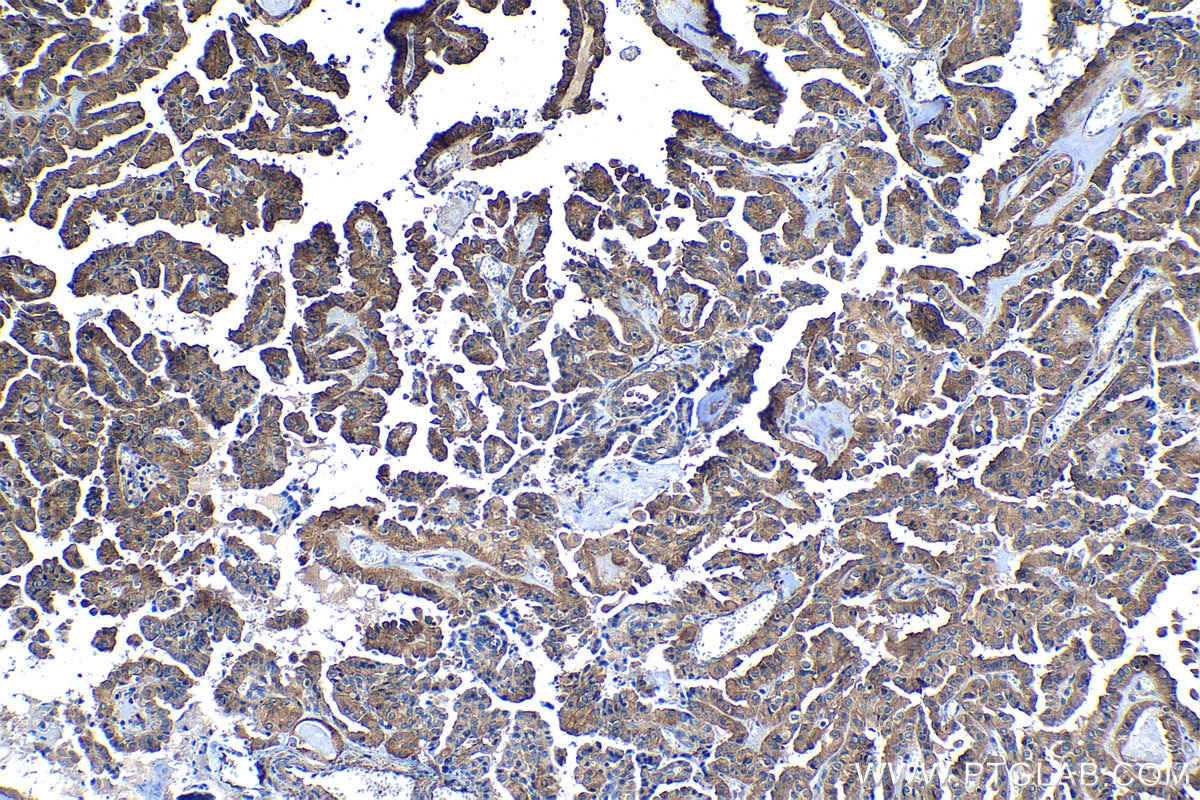 Immunohistochemical analysis of paraffin-embedded human thyroid cancer tissue slide using KHC1204 (EIF4A2 IHC Kit).