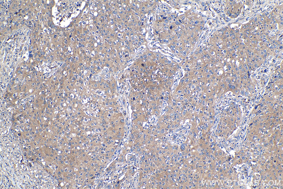 Immunohistochemical analysis of paraffin-embedded human lung cancer tissue slide using KHC1204 (EIF4A2 IHC Kit).