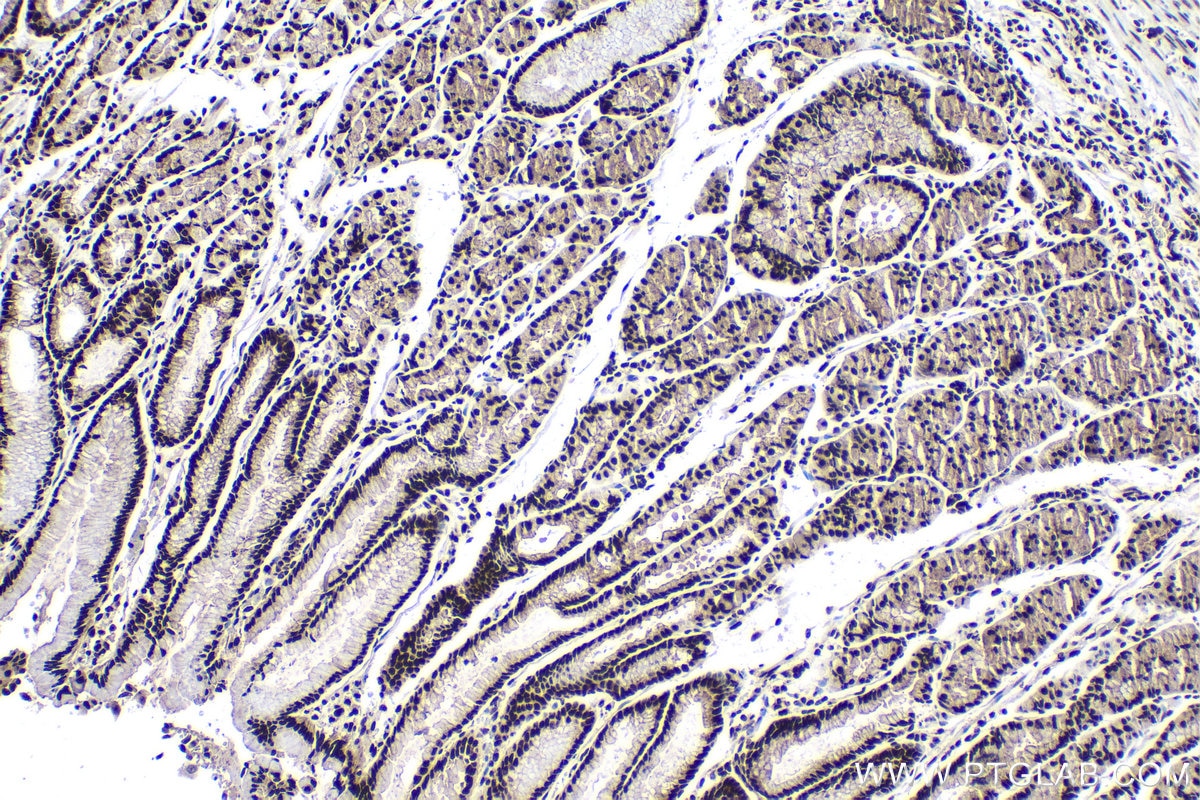 Immunohistochemical analysis of paraffin-embedded human stomach cancer tissue slide using KHC1588 (EIF4A3 IHC Kit).