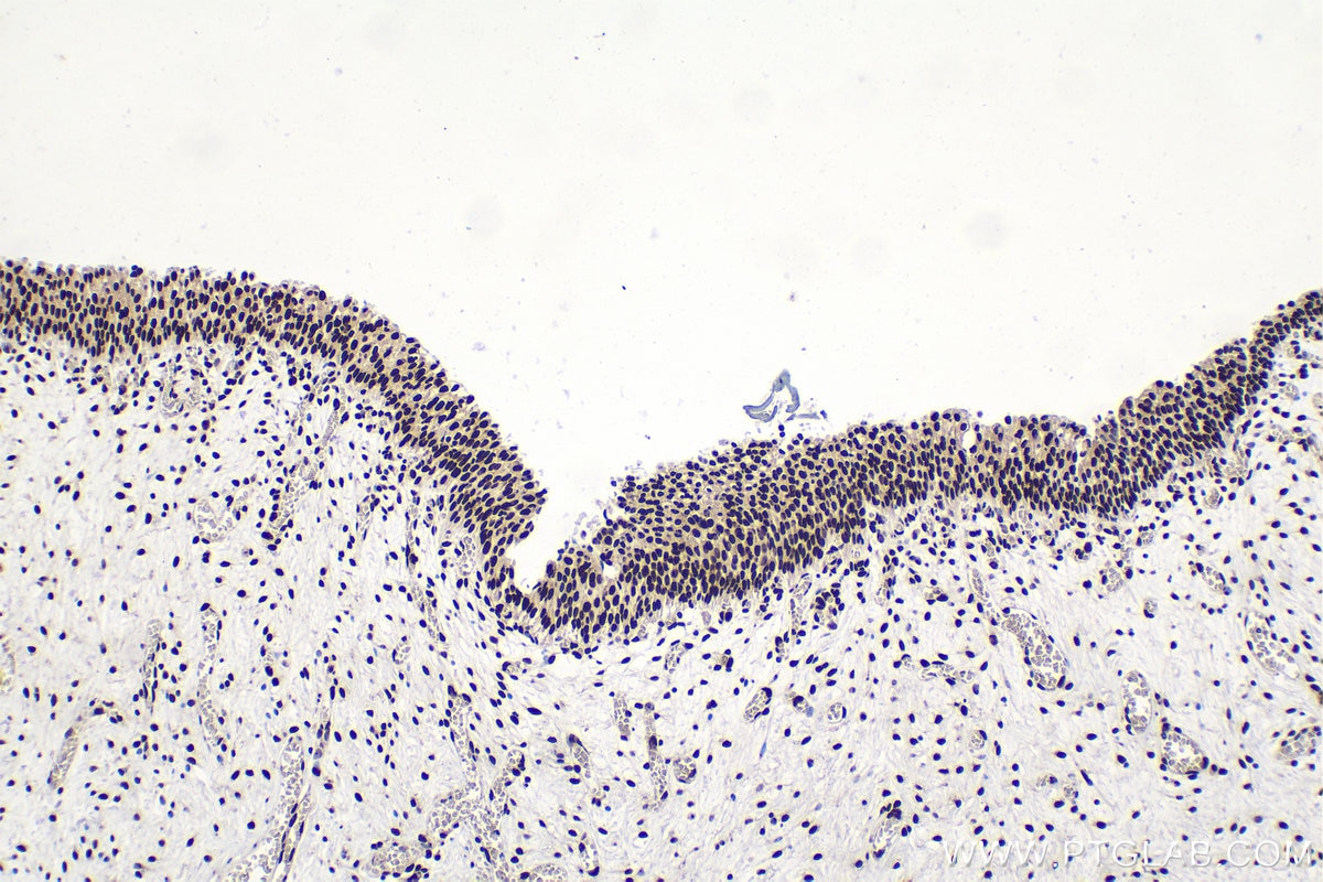 Immunohistochemical analysis of paraffin-embedded human urothelial carcinoma tissue slide using KHC1588 (EIF4A3 IHC Kit).