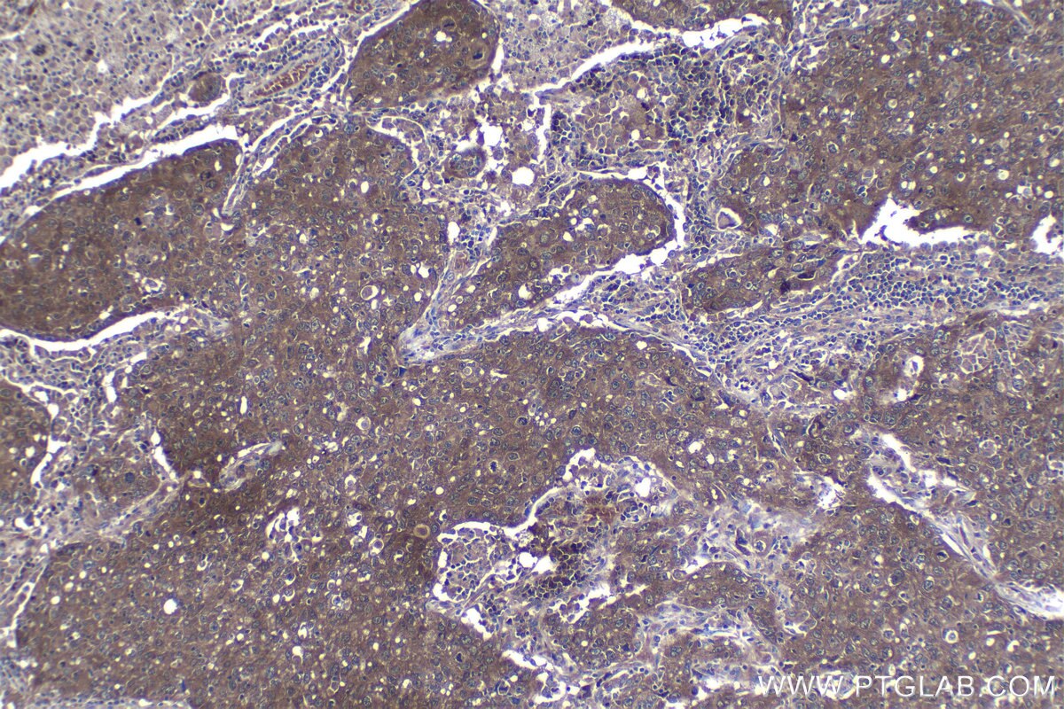 Immunohistochemical analysis of paraffin-embedded human lung cancer tissue slide using KHC1205 (EIF4E IHC Kit).