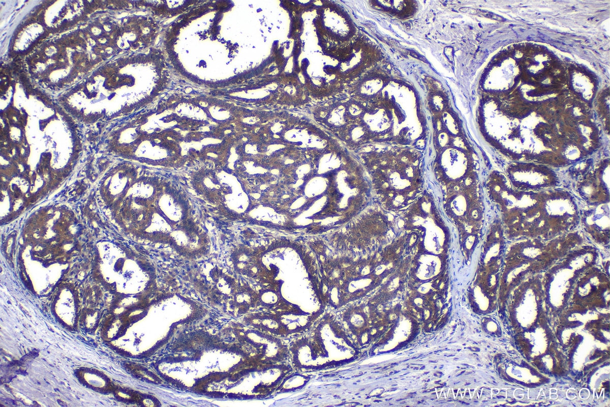 Immunohistochemical analysis of paraffin-embedded human breast cancer tissue slide using KHC1205 (EIF4E IHC Kit).