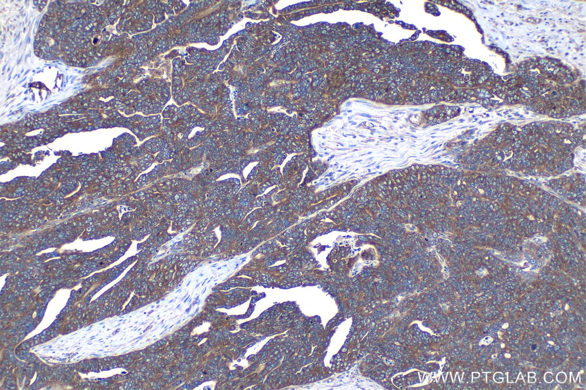 Immunohistochemical analysis of paraffin-embedded human ovary tumor tissue slide using KHC1206 (EIF4G1 IHC Kit).