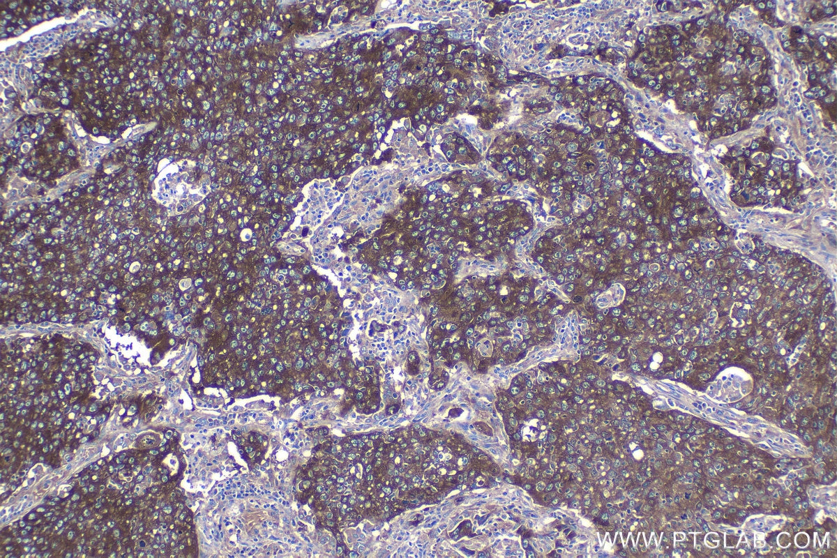Immunohistochemical analysis of paraffin-embedded human lung cancer tissue slide using KHC1206 (EIF4G1 IHC Kit).