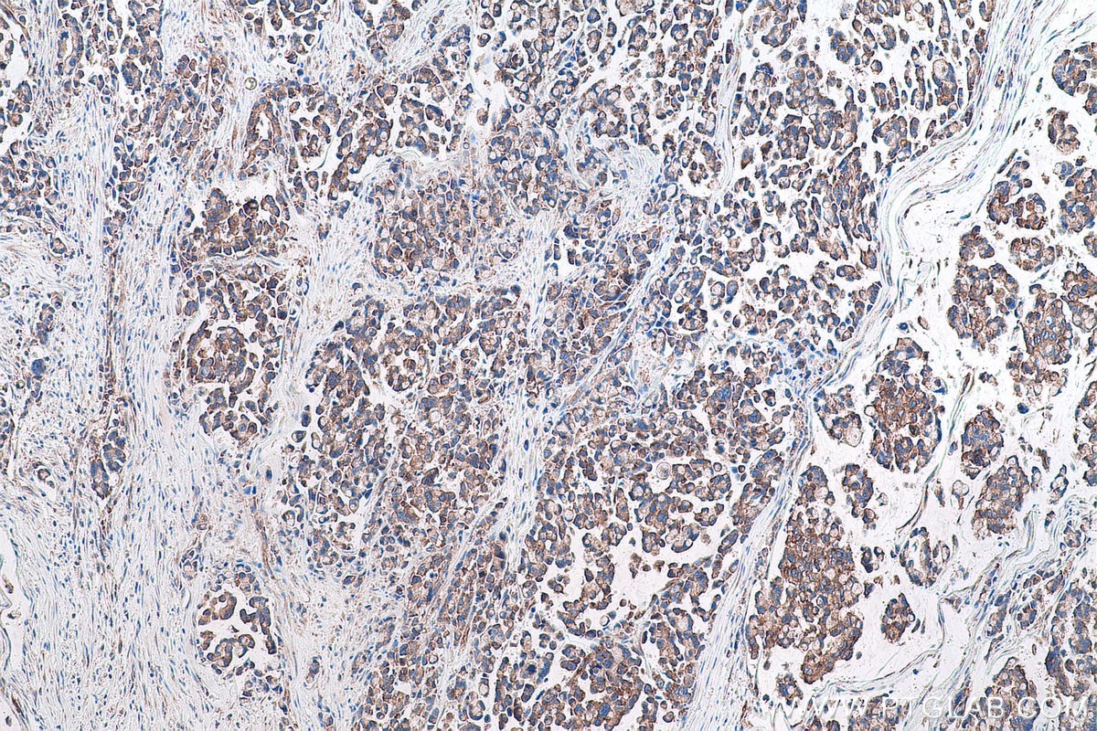 Immunohistochemical analysis of paraffin-embedded human colon cancer tissue slide using KHC0927 (EIF4G2 IHC Kit).