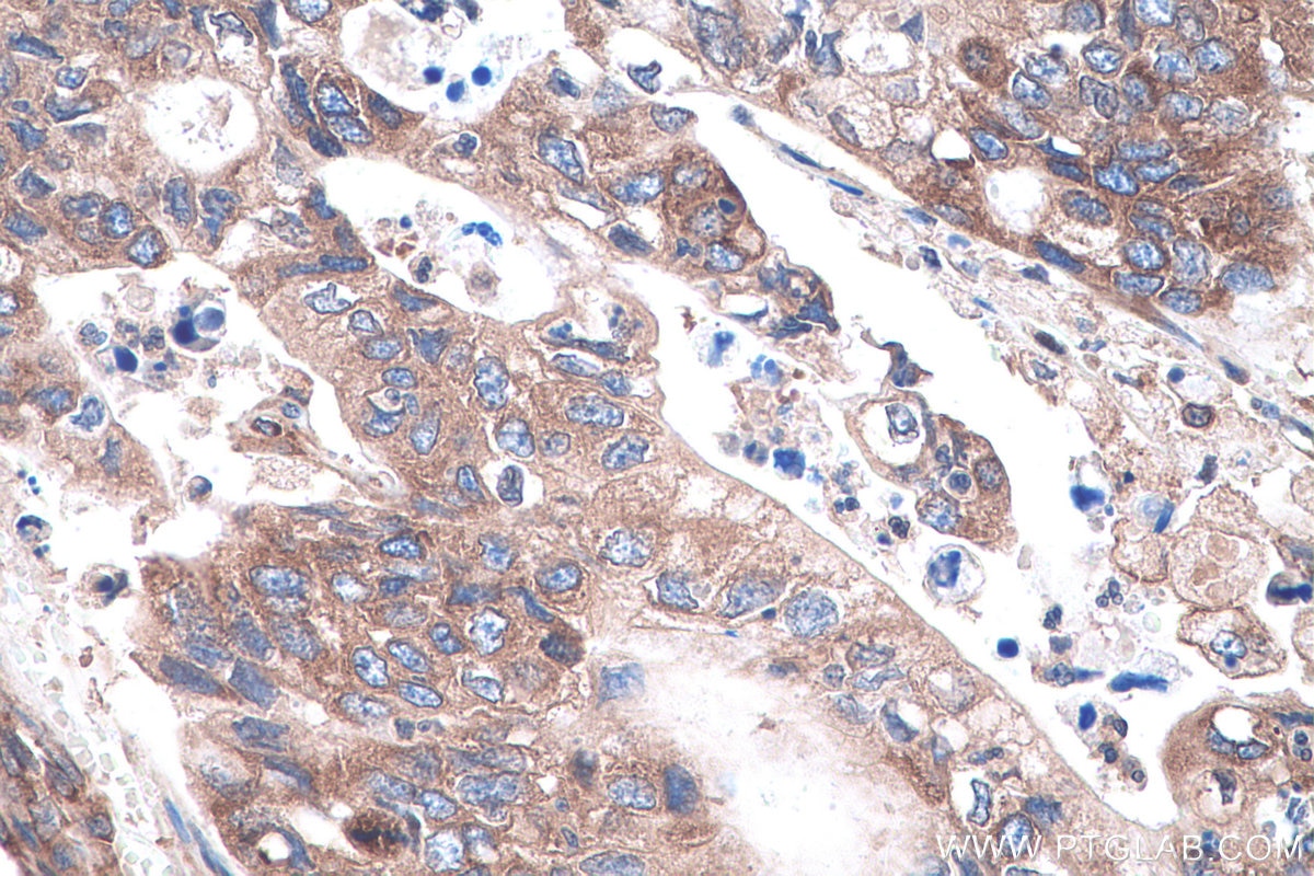 Immunohistochemical analysis of paraffin-embedded human stomach cancer tissue slide using KHC0927 (EIF4G2 IHC Kit).