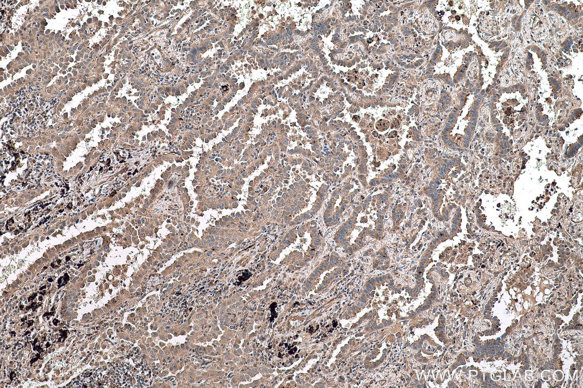 Immunohistochemical analysis of paraffin-embedded human lung cancer tissue slide using KHC0596 (EIF5A IHC Kit).