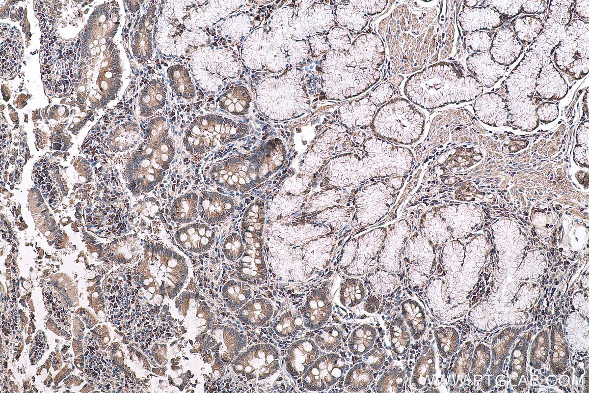 Immunohistochemical analysis of paraffin-embedded human stomach cancer tissue slide using KHC0596 (EIF5A IHC Kit).