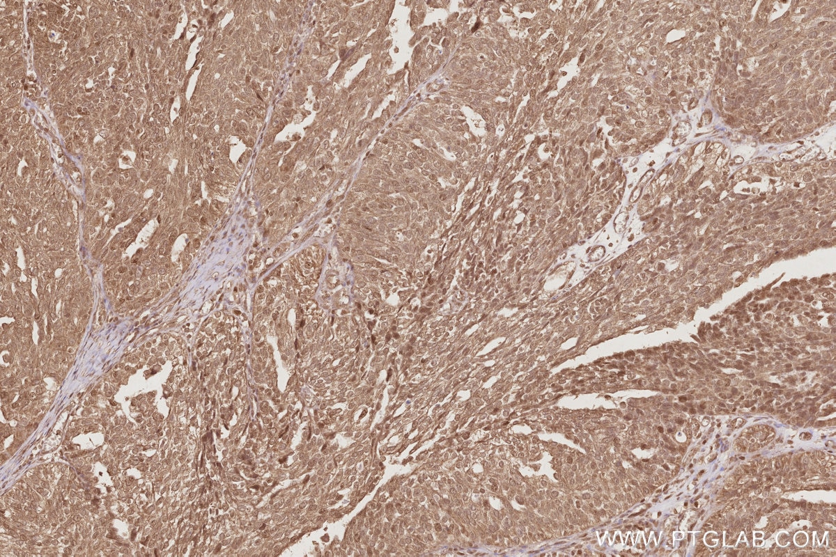 Immunohistochemical analysis of paraffin-embedded human ovary cancer tissue slide using KHC2896 (EIF5A1/EIF5A2 IHC Kit).