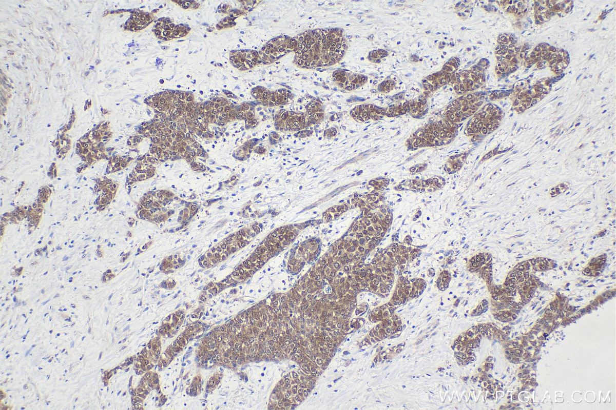 Immunohistochemical analysis of paraffin-embedded human urothelial carcinoma tissue slide using KHC1632 (EIF6 IHC Kit).