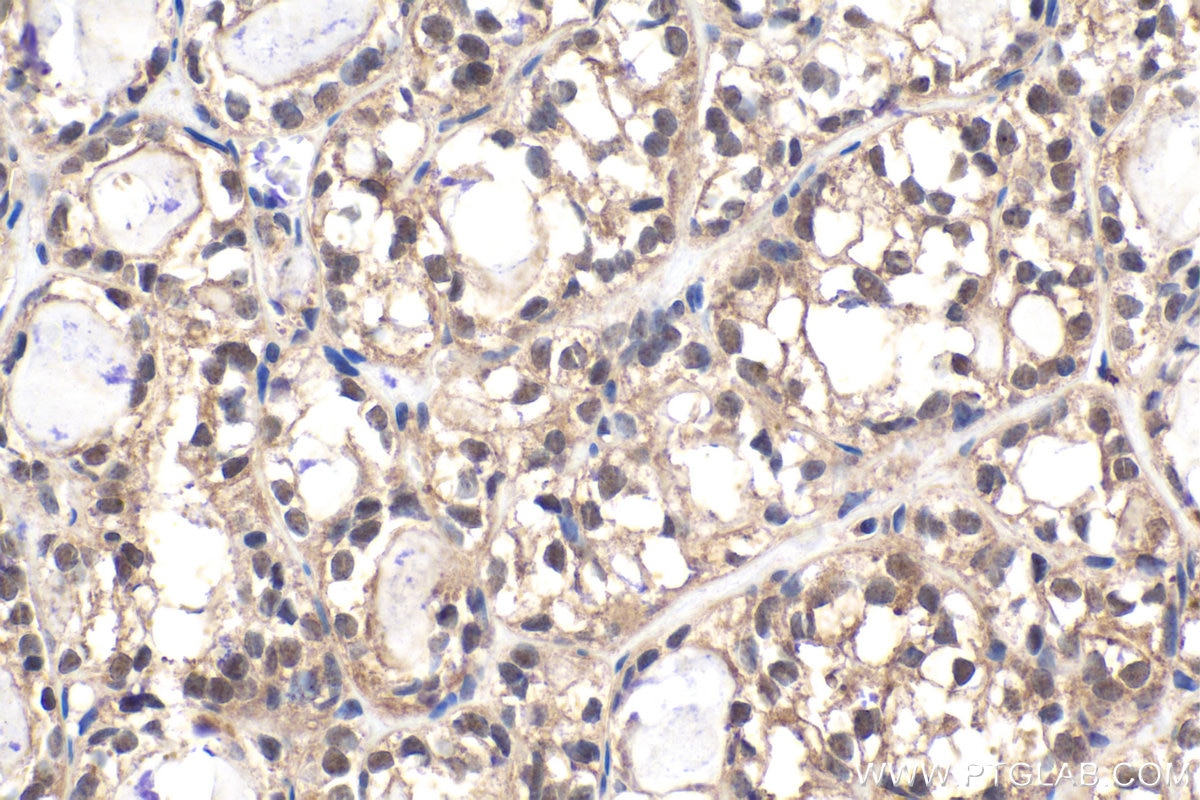 Immunohistochemical analysis of paraffin-embedded human thyroid cancer tissue slide using KHC1632 (EIF6 IHC Kit).